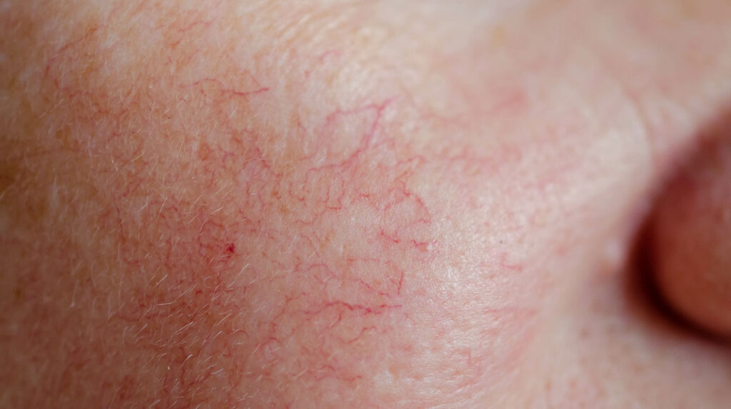 Temporary Redness from fat freezing