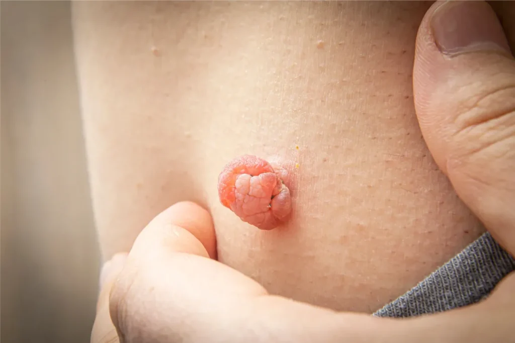 skin tag