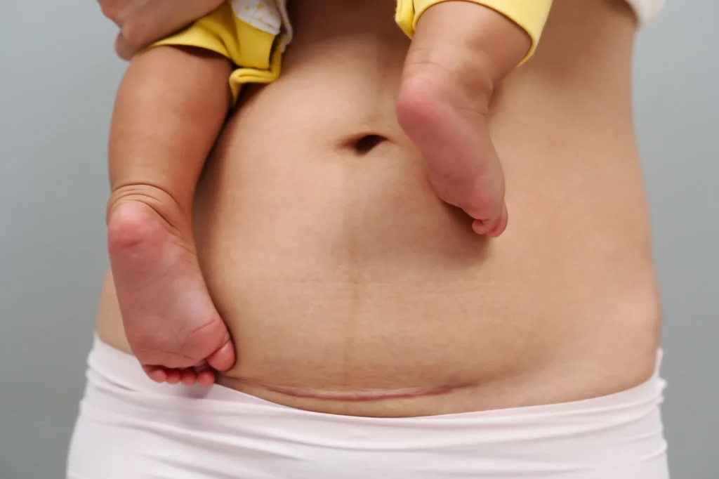 c section scar