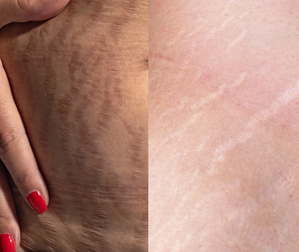 stretch marks