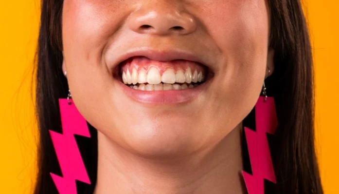 Gummy Smiles Treatment: Aesthetic Solutions in Singapore