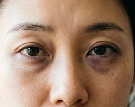Under Eye Filler Singapore: Refresh Tired Eyes & Dark Circles