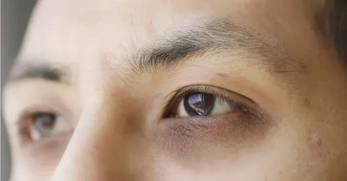 A Guide to Dark Eye Circle Removal in Singapore