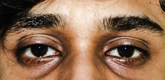 A Guide to Dark Eye Circle Removal in Singapore