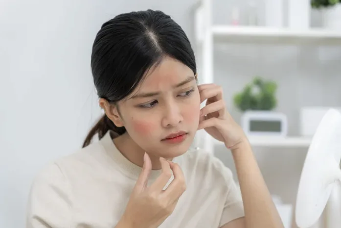 Rosacea Treatment Singapore