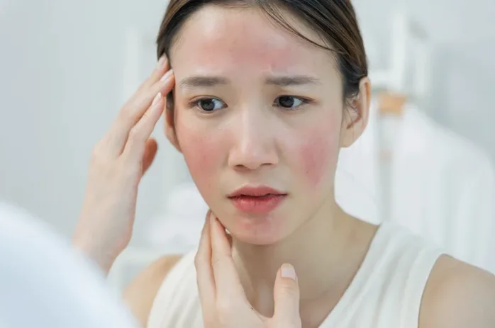 Rosacea Treatment Singapore