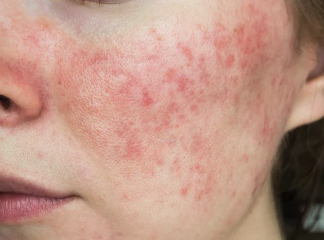 Rosacea Treatment Singapore
