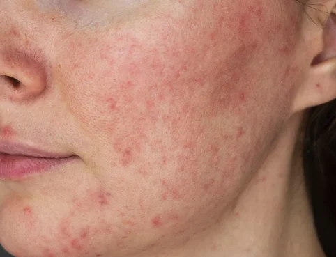 Rosacea Treatment Singapore