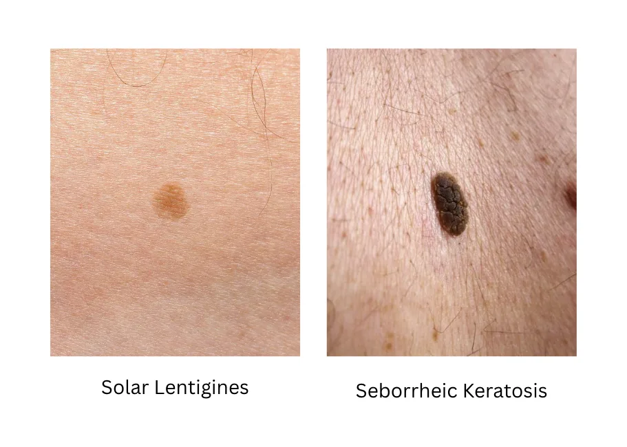 Guide to Age Spots Treatment in Singapore