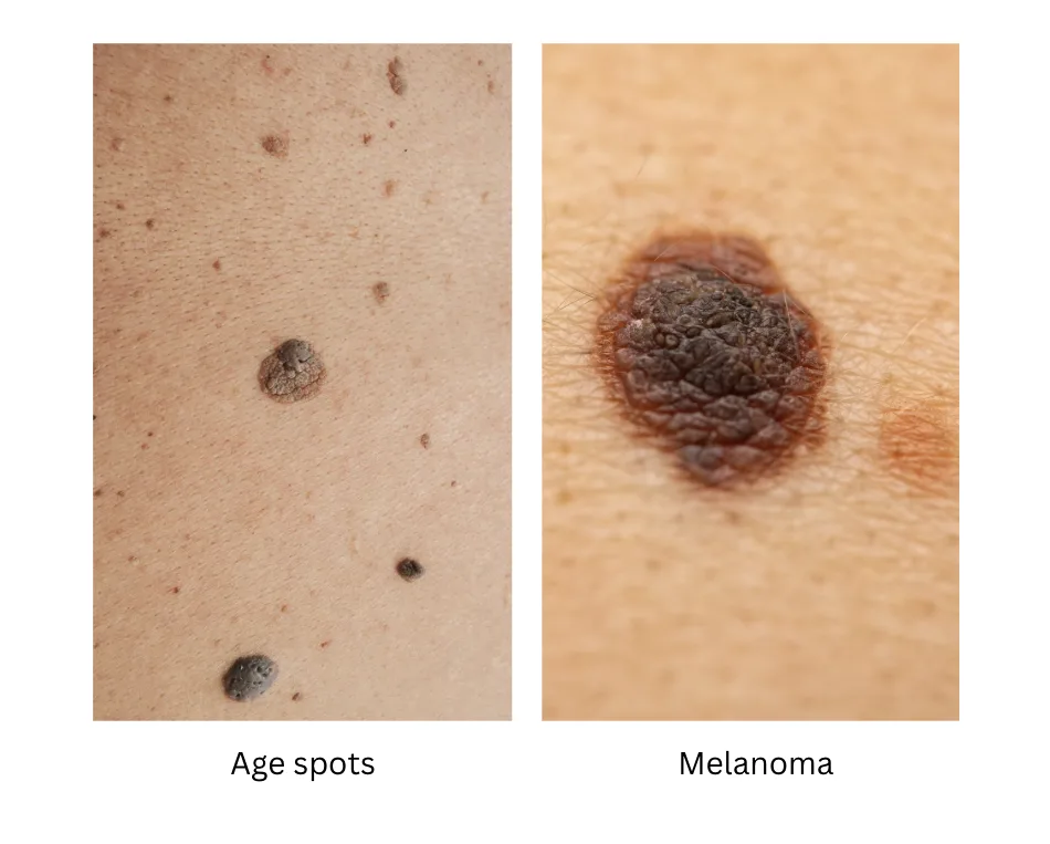Guide to Age Spots Treatment in Singapore