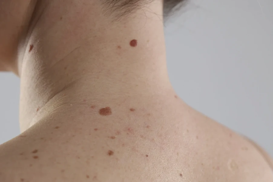 Guide to Age Spots Treatment in Singapore