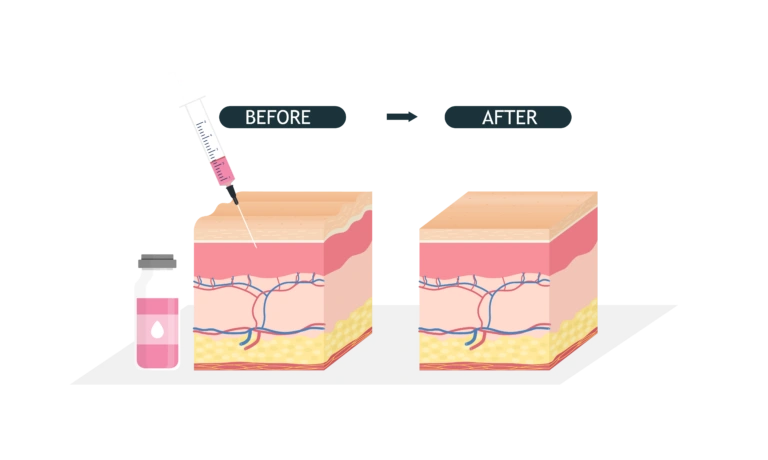Before and after skin layer diagram showing volume restoration to explain How long does collagen stimulator last Singapore.