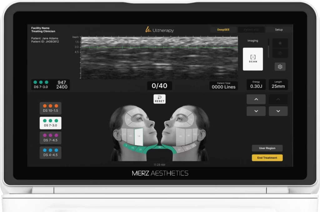 Digital monitor interface showing ultrasound imaging and facial treatment mapping to demonstrate What is the difference between ultherapy and ultherapy prime.