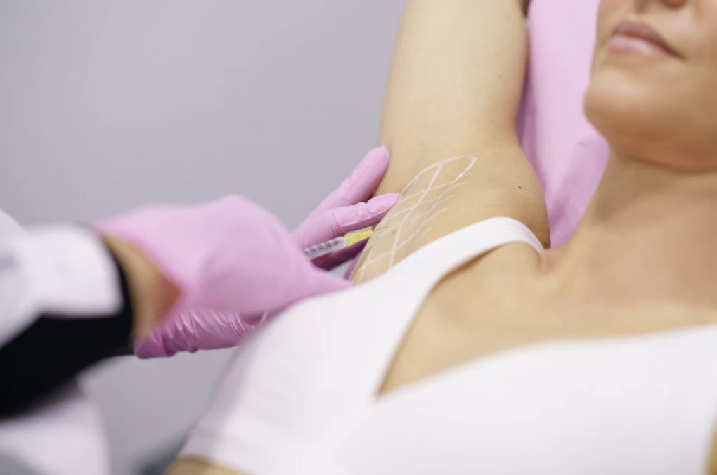 Medical practitioner giving precision injections to a patient's marked axilla during an Underarm Sweating Treatment.